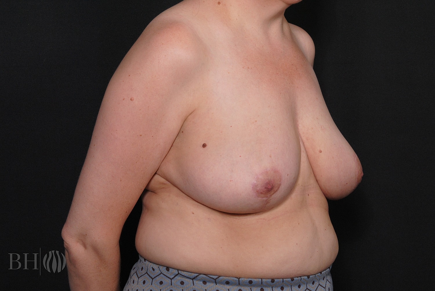 Breast Reduction Before & After