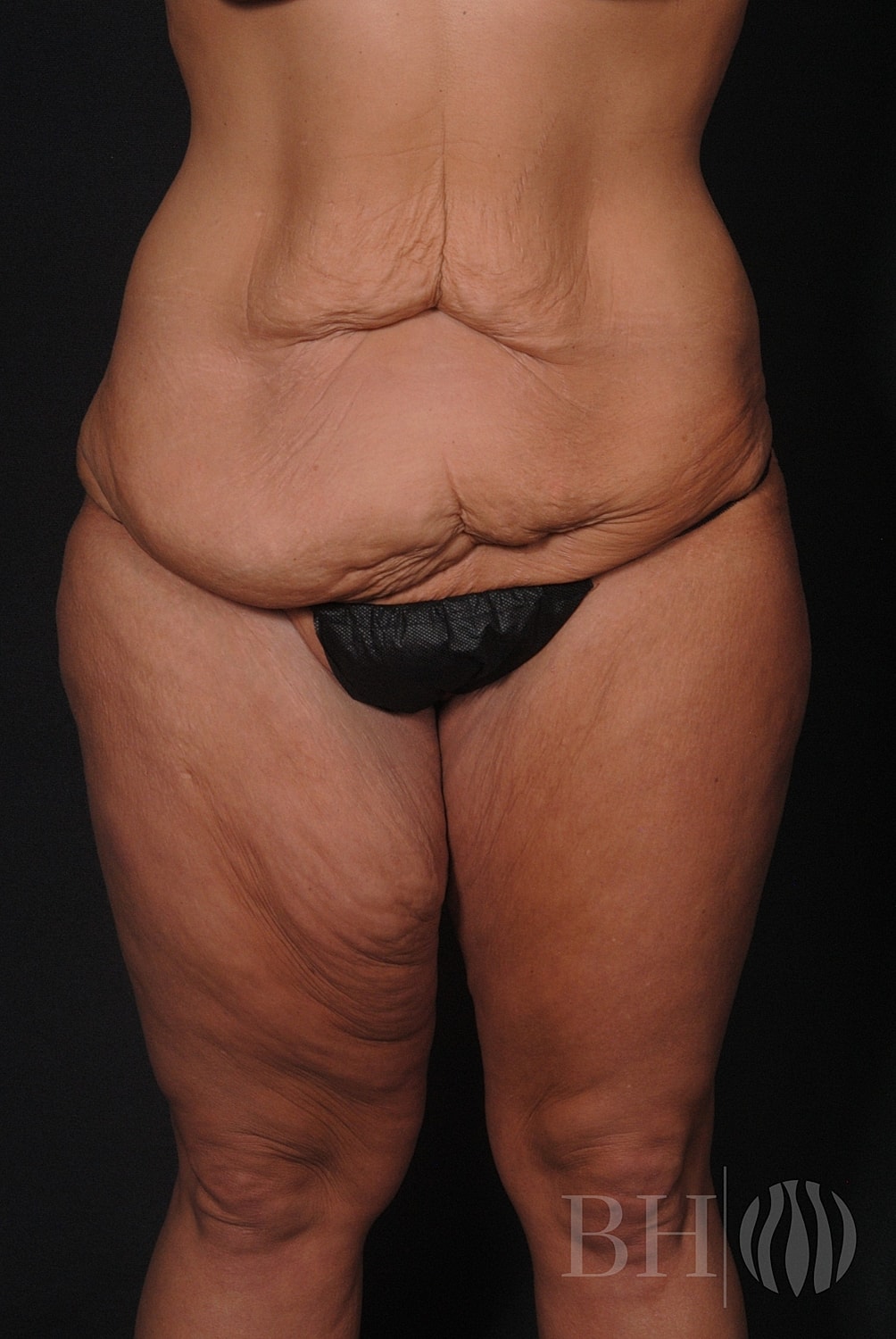 Body Lift Before & After