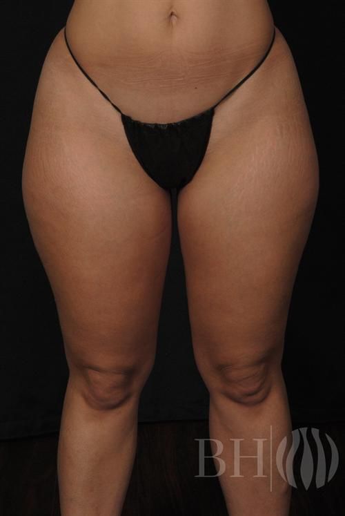Liposuction Before & After