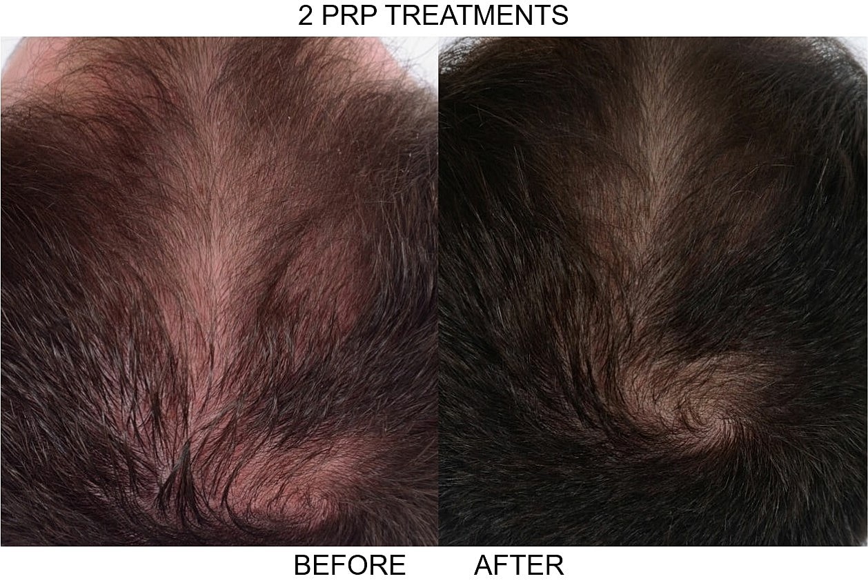 Before and after PRP hair treatment results.