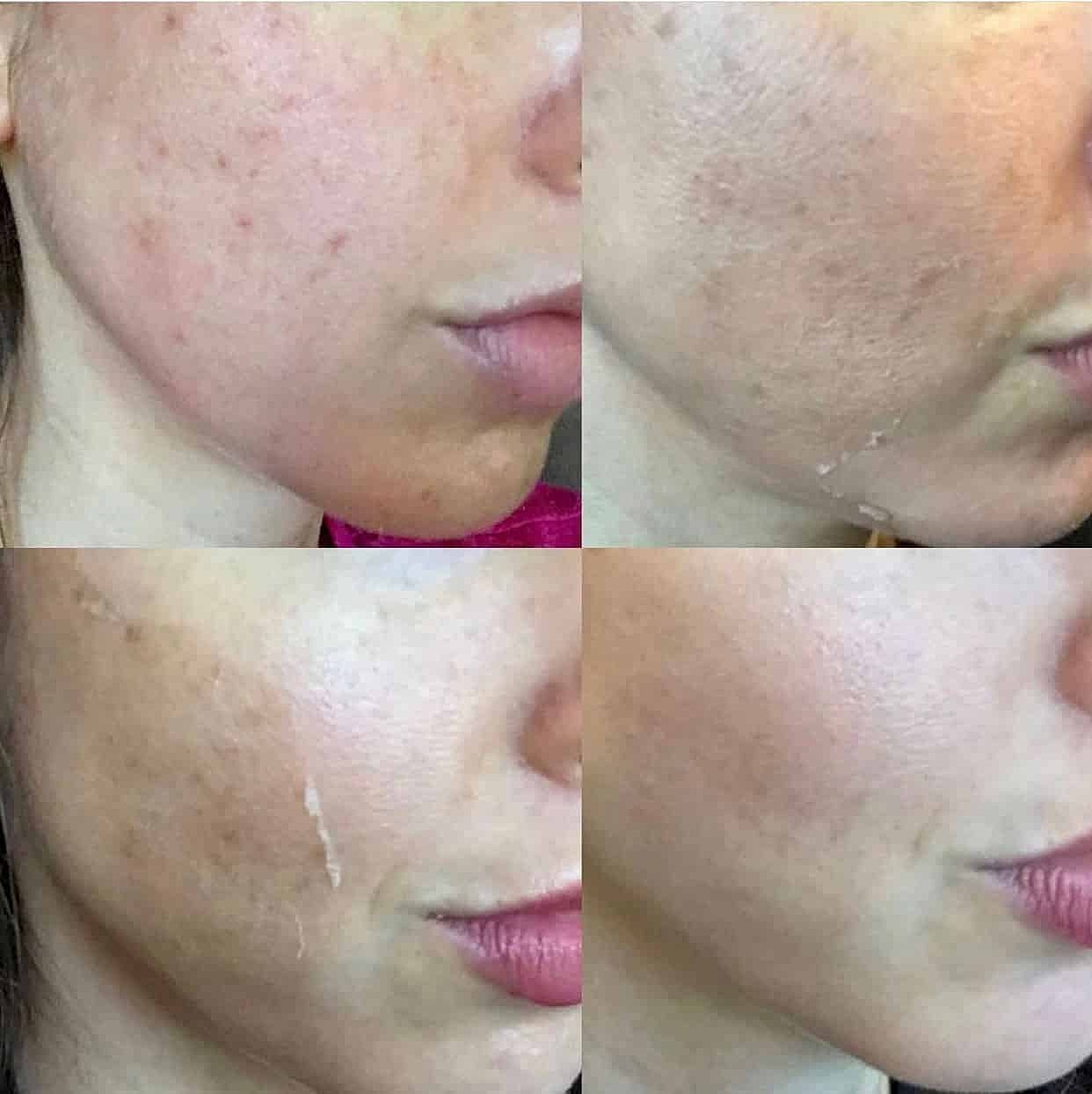 But the Sun Dries Out my Acne...