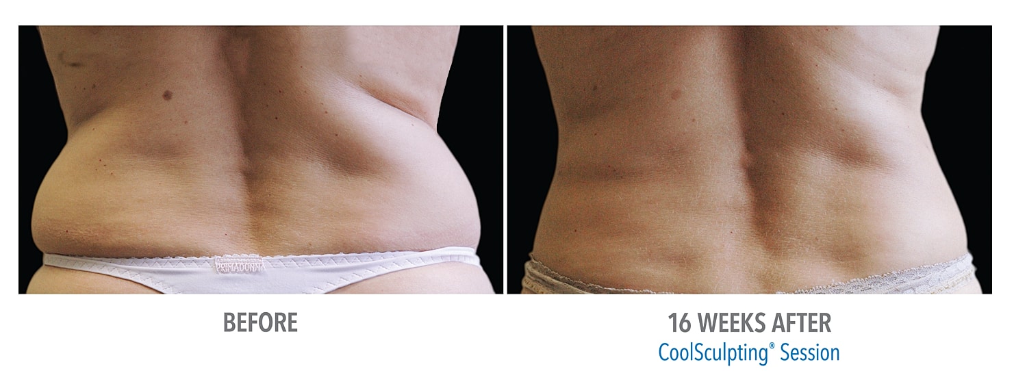 CoolSculpting - New Treatment Areas