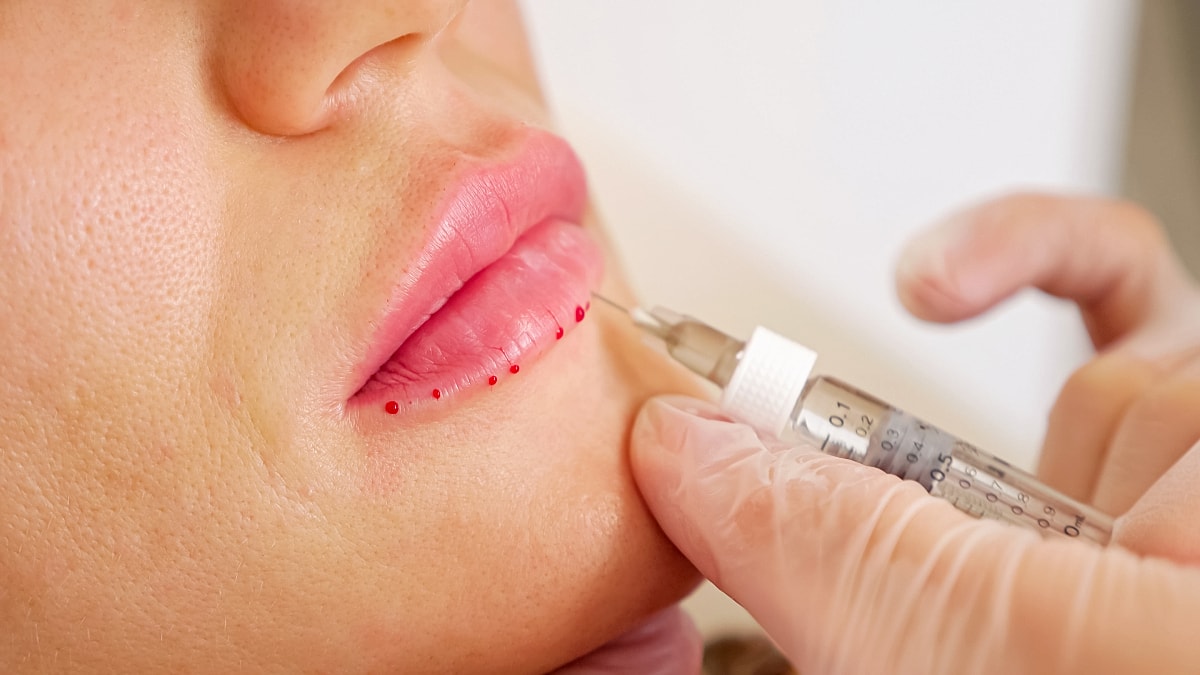 Maintaining Filler Results: Dos and Don'ts for Optimal Outcomes