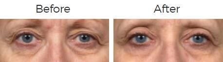 Thermage Before & After