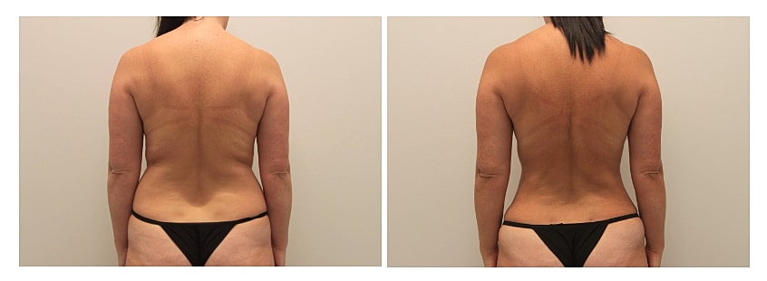 360 degree liposuction before and after in a back view demonstrating smoother, more contoured lines through the waist and lower back. The after image shows a refined silhouette with improved definition and a more sculpted appearance across the torso.