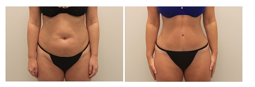 360 degree liposuction before and after in a front view highlighting a smoother, flatter abdomen and a more sculpted waistline. The after image demonstrates refined midsection contours and enhanced overall abdominal definition for a balanced, streamlined appearance.