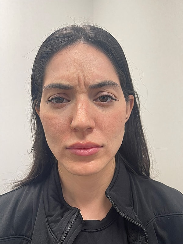 Botox Glabella Before & After