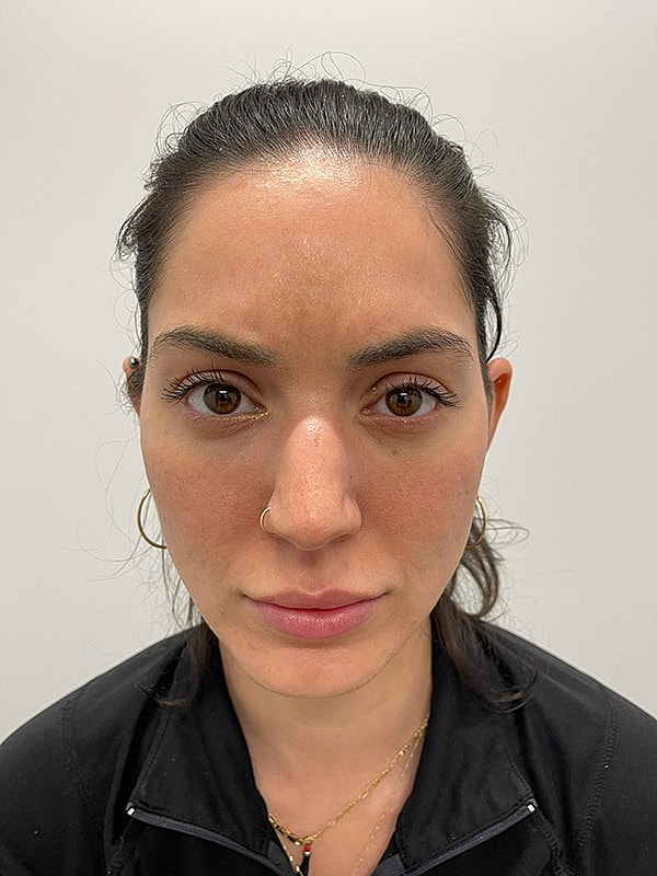 Botox Glabella Before & After