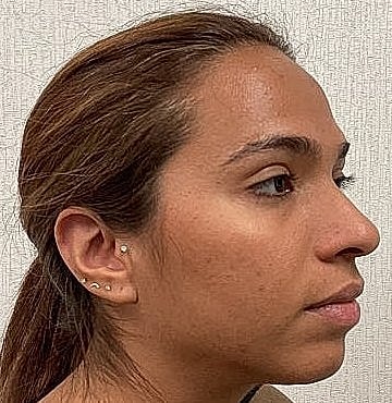 Dermal Filler Before & After