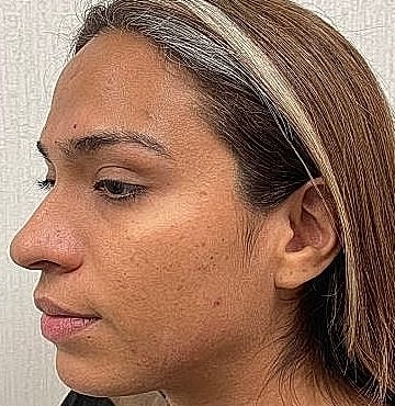 Dermal Filler Before & After