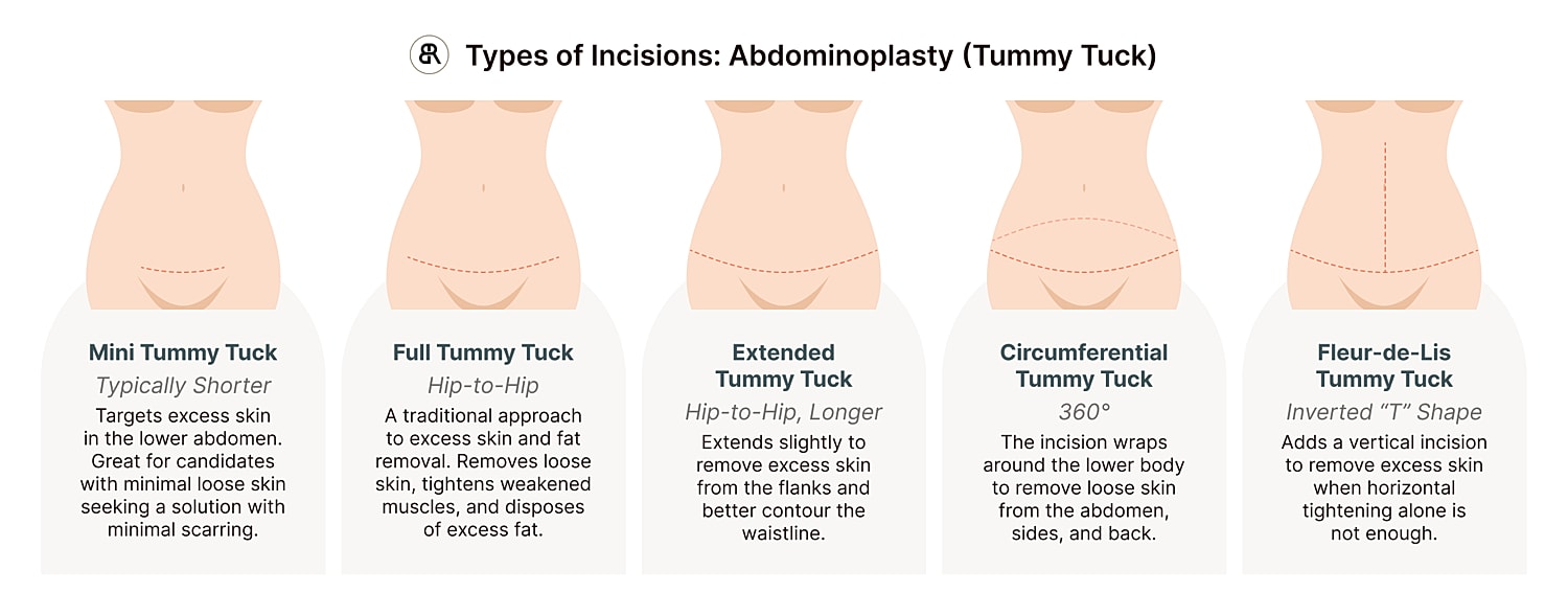 Houston tummy tuck incision infographic