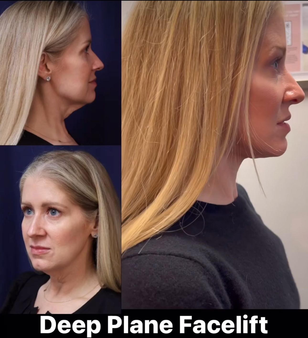 #facialrejuvenation come in all shapes and sizes. This beautiful patient had lost weight and was left with laxity in her neck and jowls.  She is 1 month out from a #deepplanefacelift and she looks amazing 🤩.