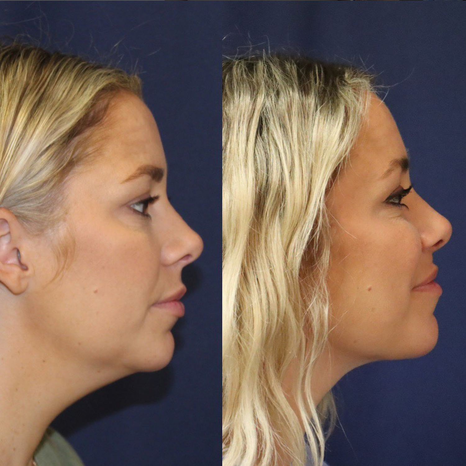 A small change can make a big difference…  This patient is 6 months out from chin and neck liposuction…(also known as submental liposuction in the plastic surgery world).  By reducing the amount of fullness under her chin, we can highlight her jawline and give better shape to the chin overall.