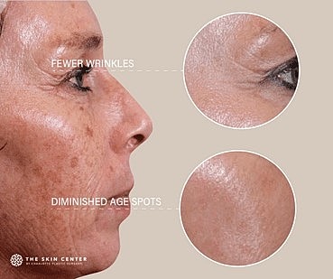 Before and after skin treatment comparison.
