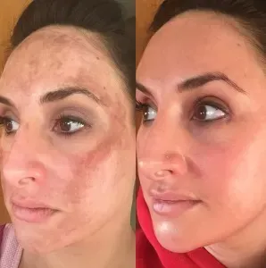 melasma treatment charlotte