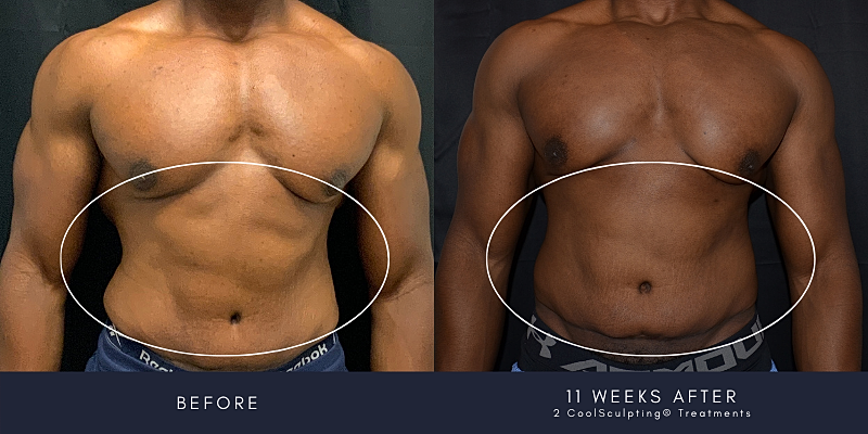 Coolsculpting Before & After