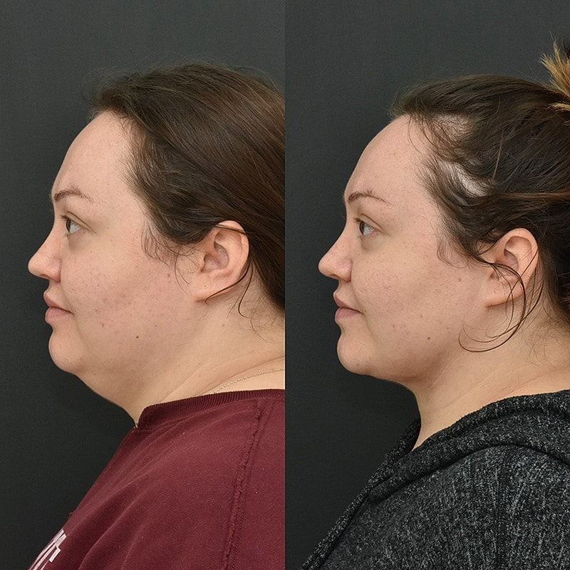 Chin Liposuction