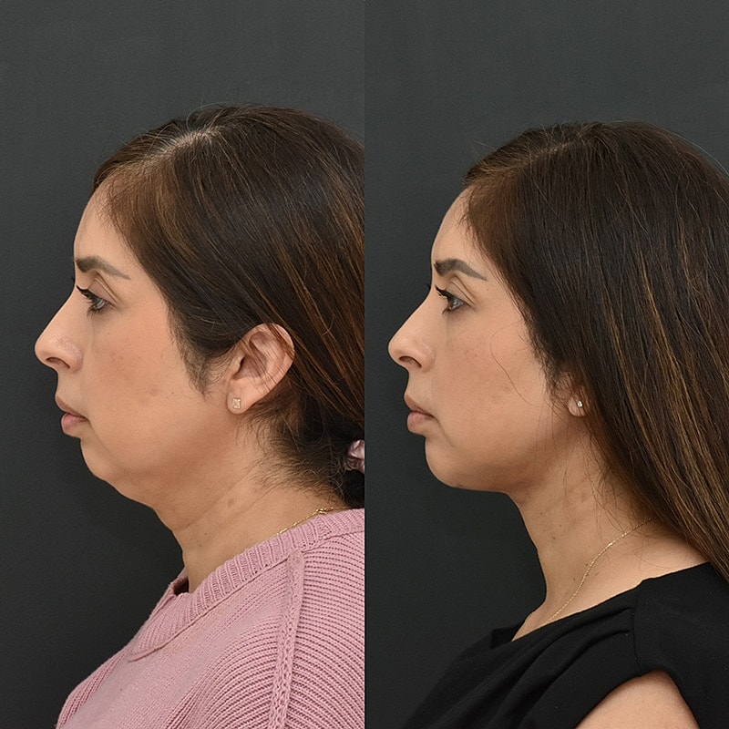 Isolated Neck Lift