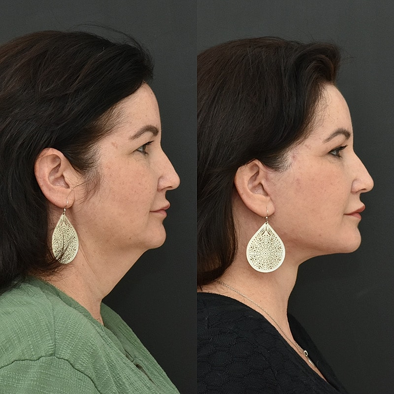 Lower Face & Neck Lift