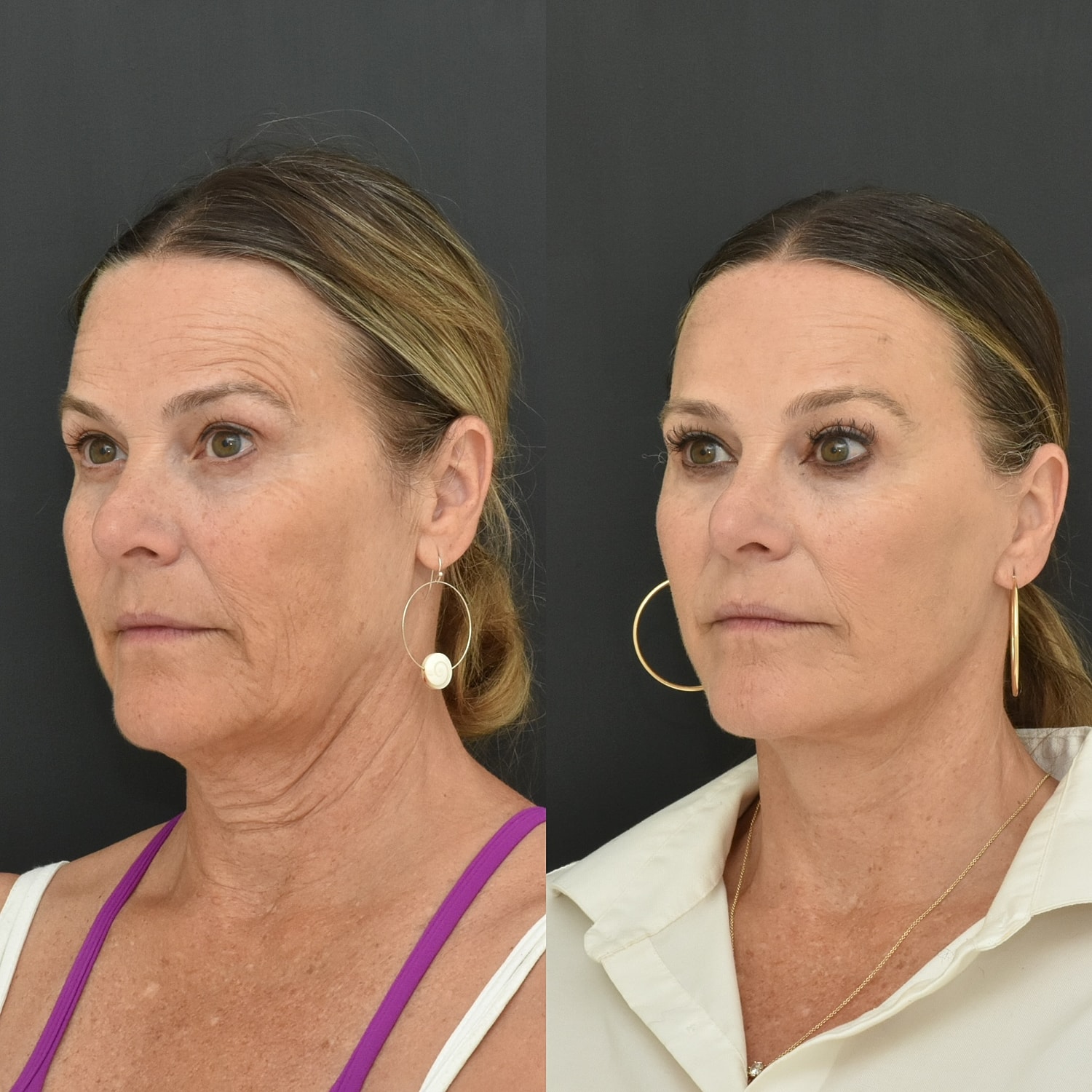 Brow Lift Before & After