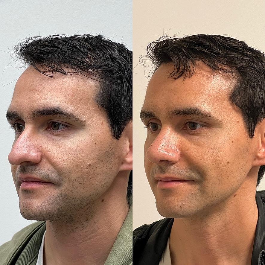 Cosmetic Primary Rhinoplasty Before & After