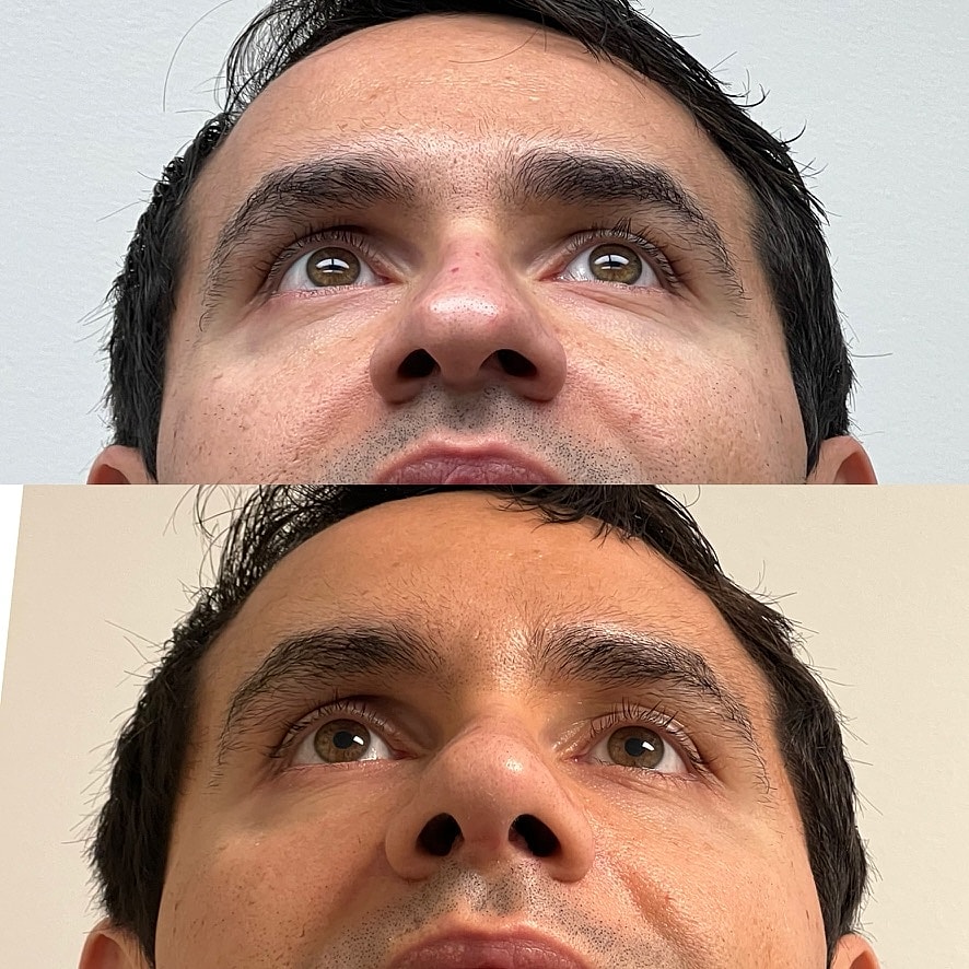 Cosmetic Primary Rhinoplasty Before & After