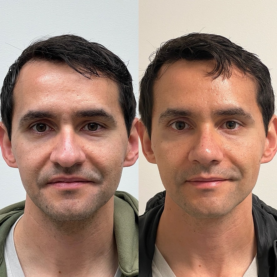Cosmetic Primary Rhinoplasty Before & After