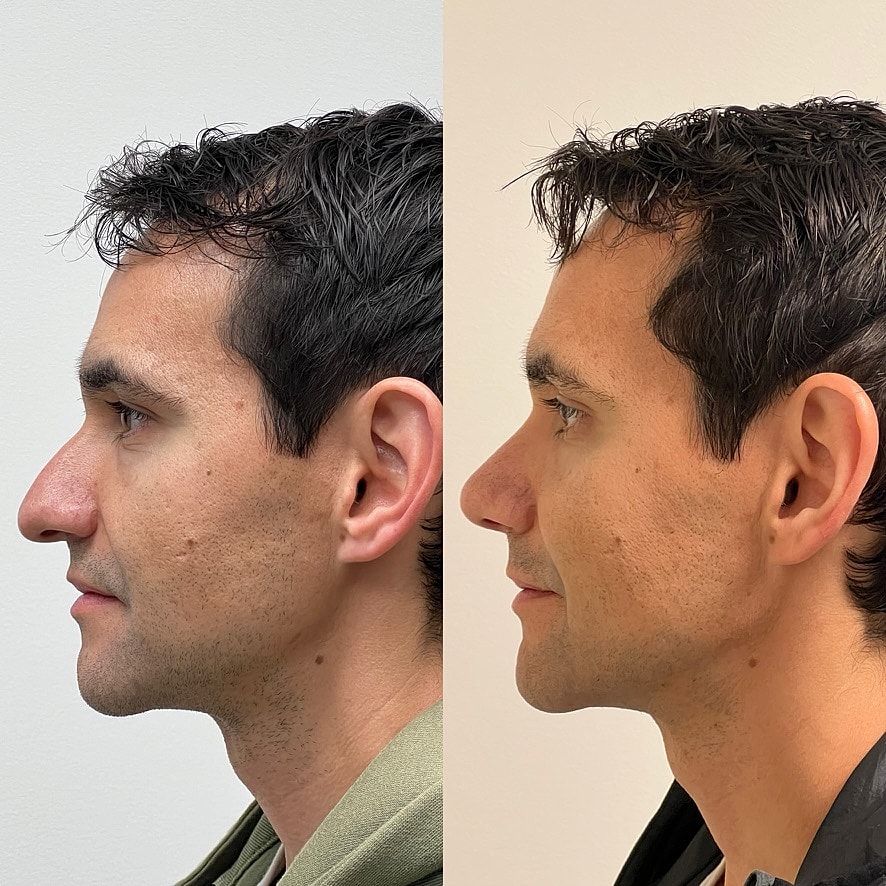 Cosmetic Primary Rhinoplasty Before & After