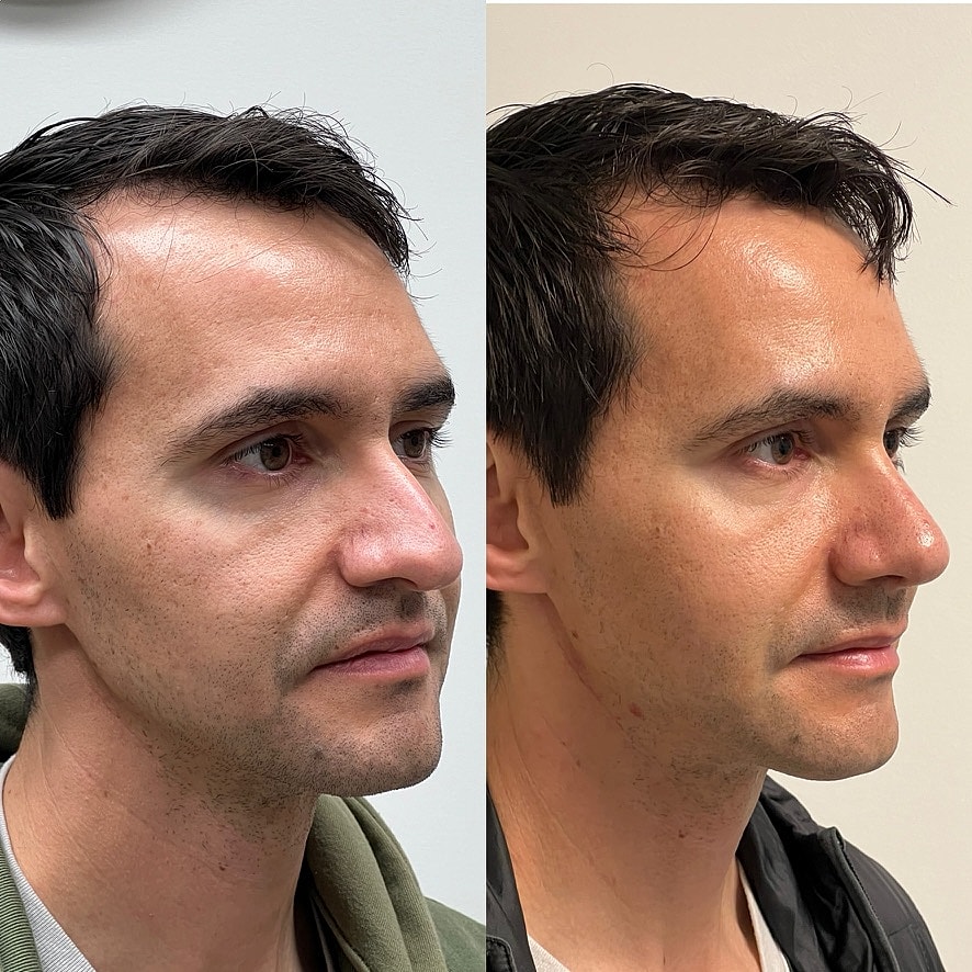 Cosmetic Primary Rhinoplasty Before & After