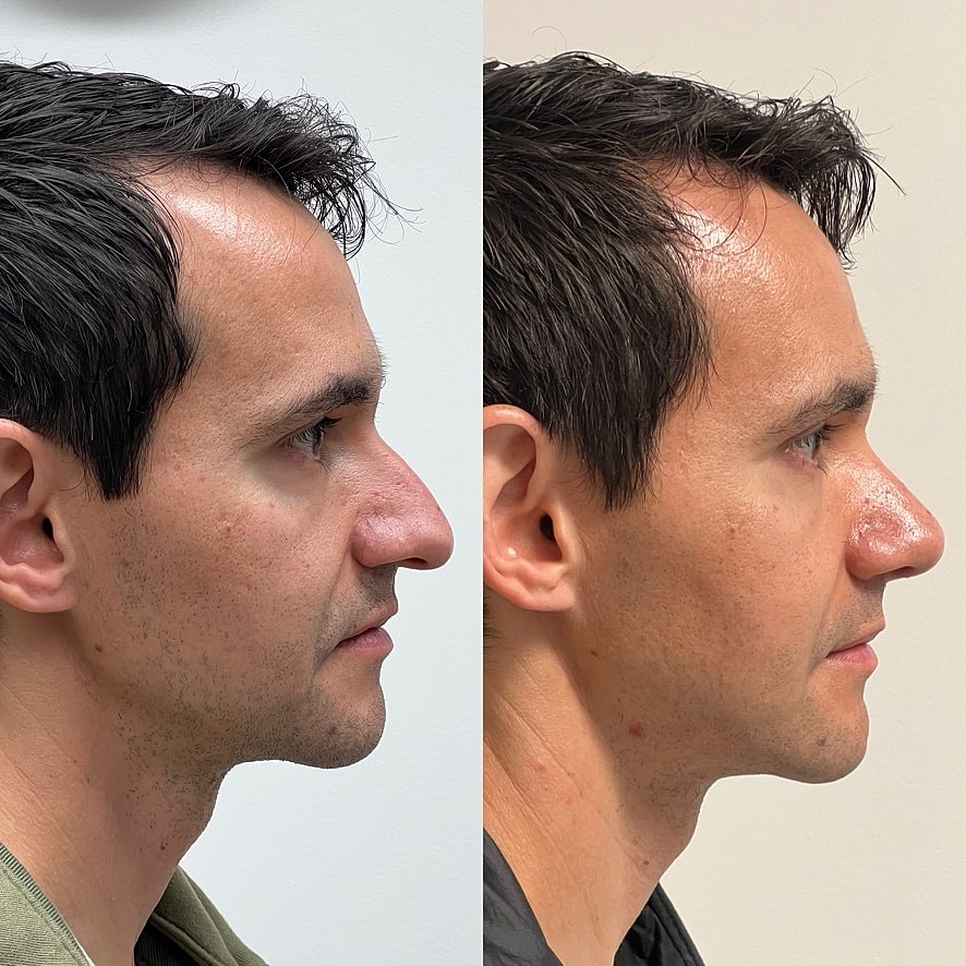 Cosmetic Primary Rhinoplasty Before & After