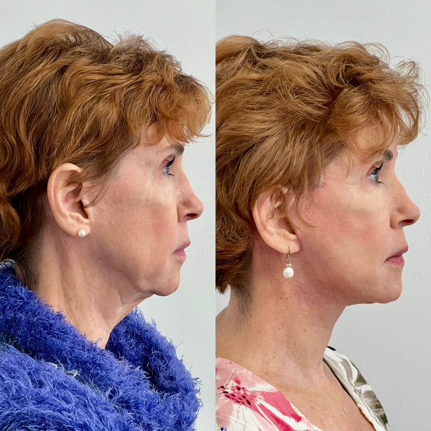 Facelift  Before & After