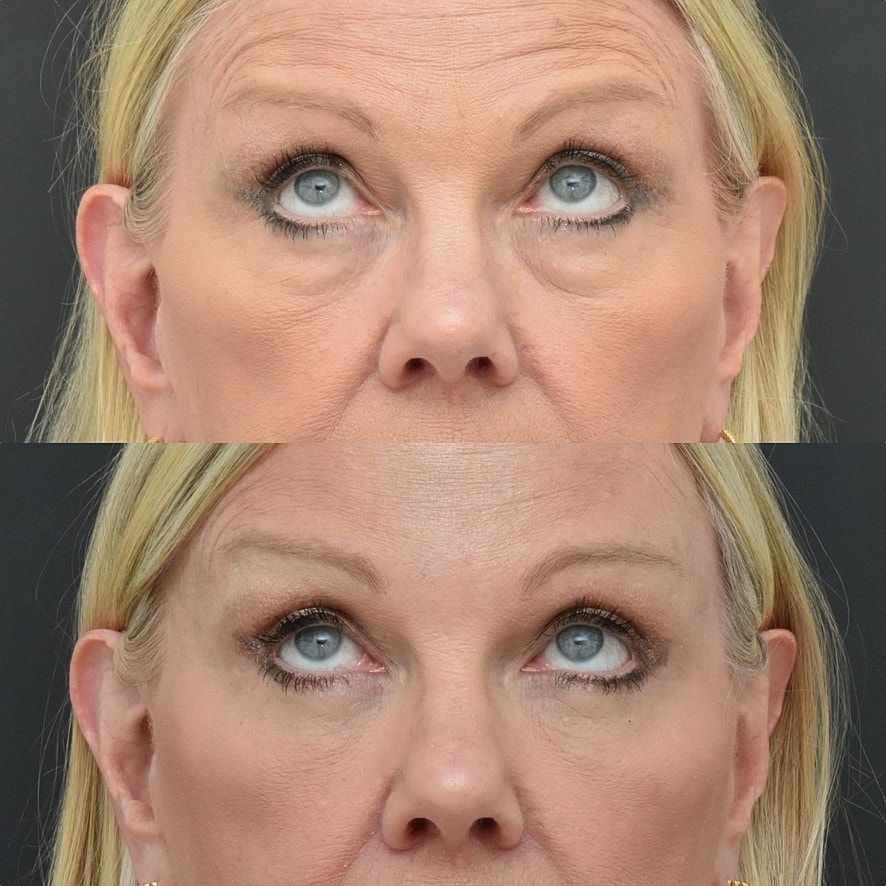 Eyelid Surgery Before & After