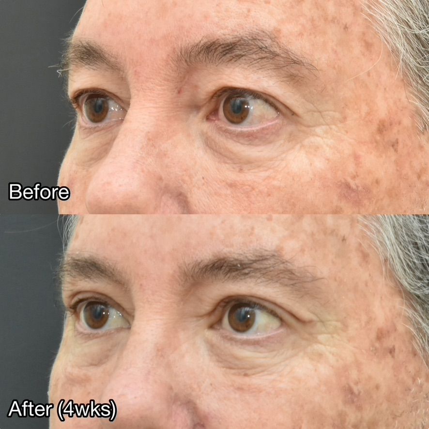 Eyelid Surgery Before & After