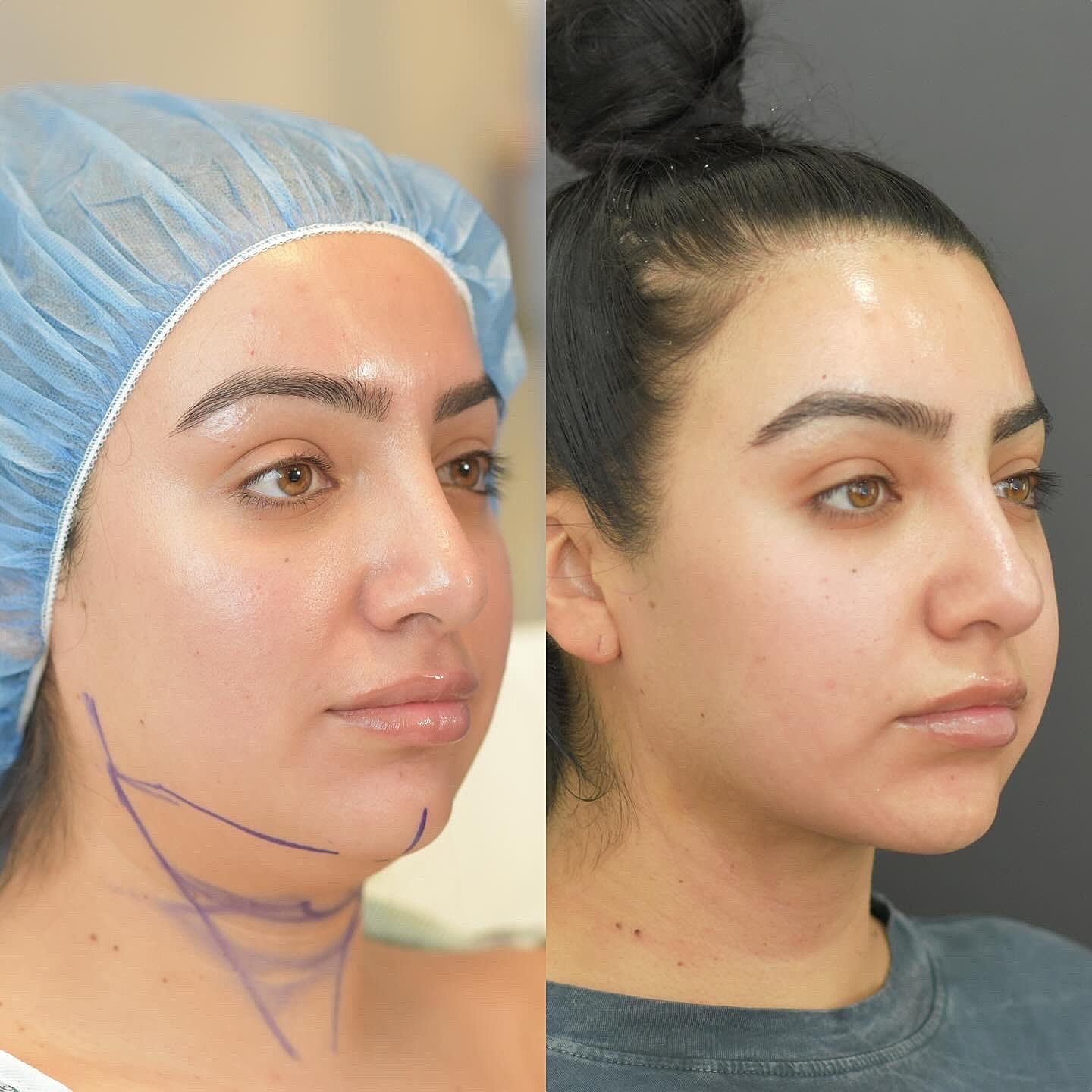 Chin Liposuction Before & After