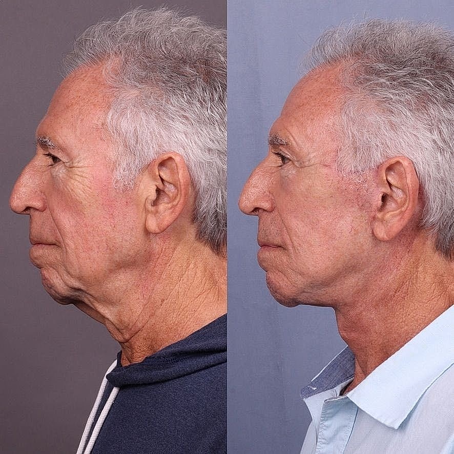 Before and after profile comparison of an older man