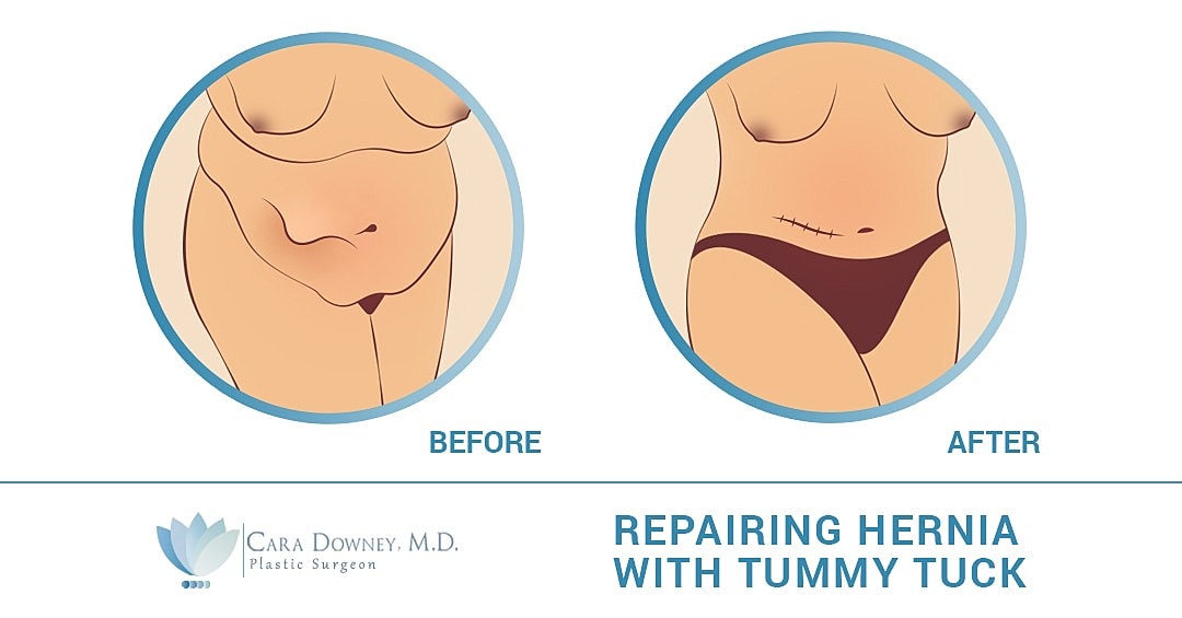 Tummy Tuck Hernia Repair: What You Need To Know