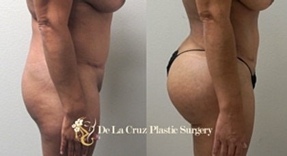 VASER Liposuction with fat transfer to the buttocks (BBL) performed by Dr. De La Cruz.