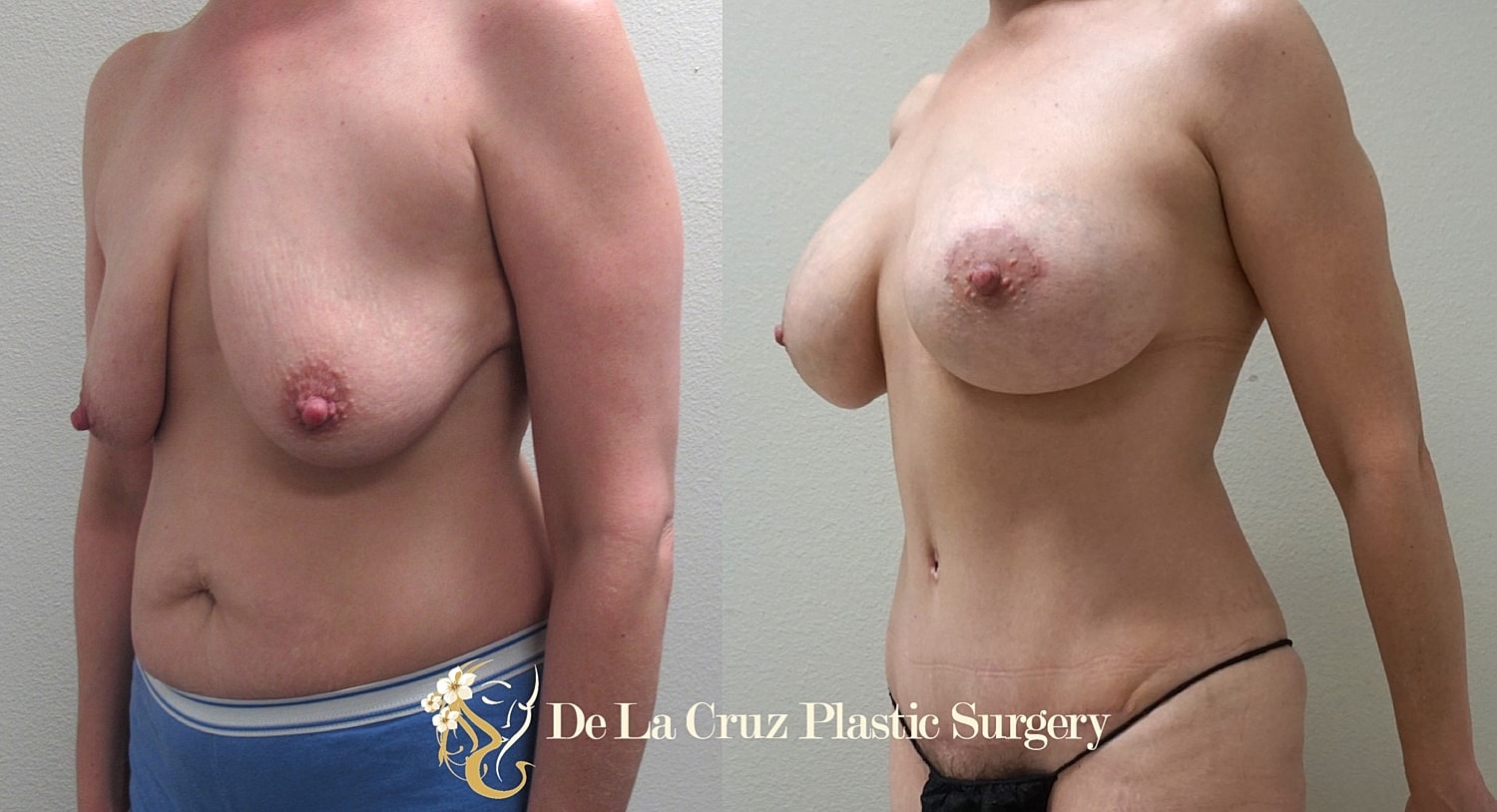 Abdominoplasty performed by Dr. De La Cruz