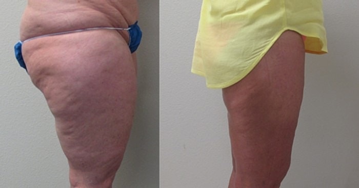 VASER Liposuction on thighs performed by Dr. De La Cruz.