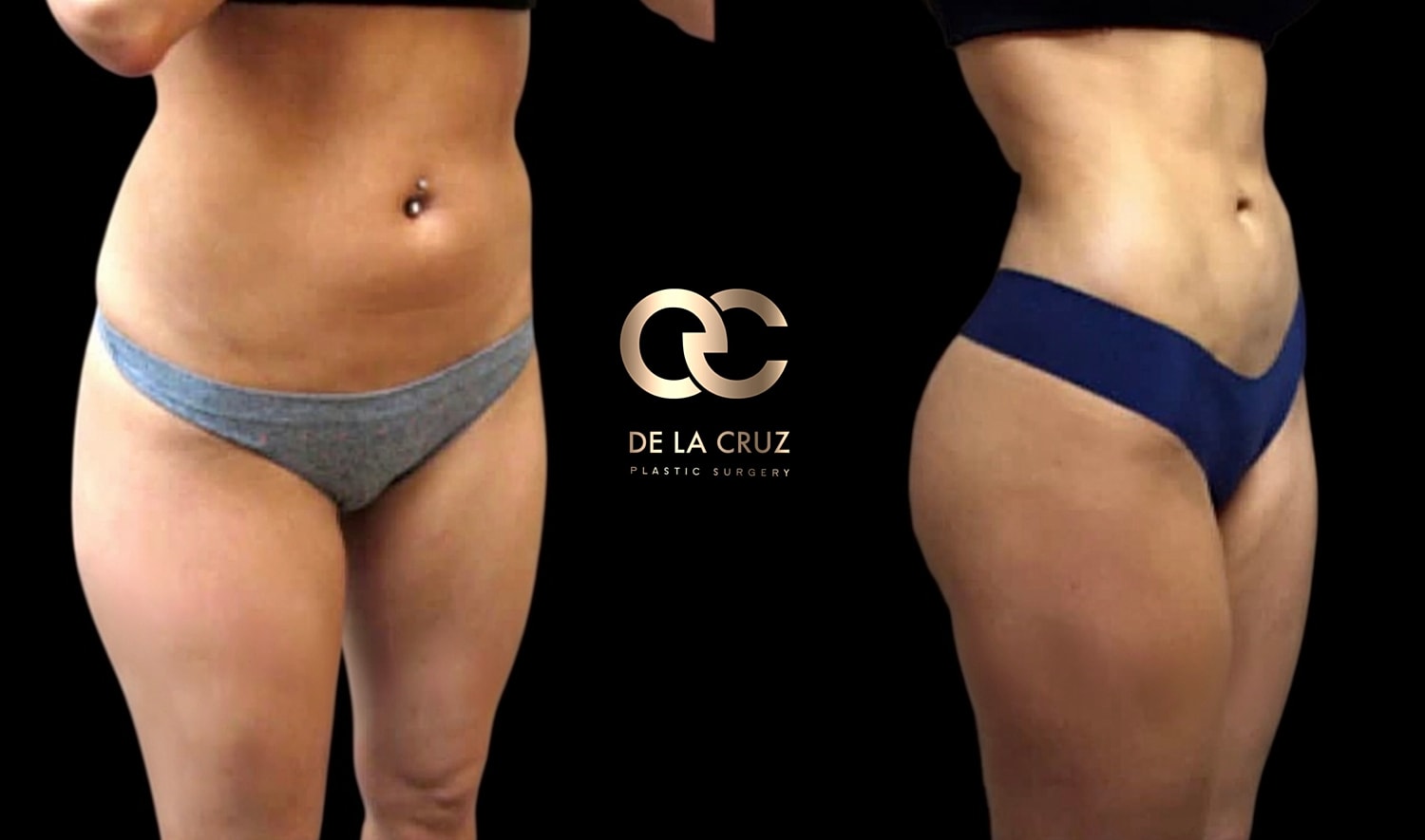 Liposuction After GLP-1 Weight Loss: Understanding Skin Retraction and the  Fibroseptal Network