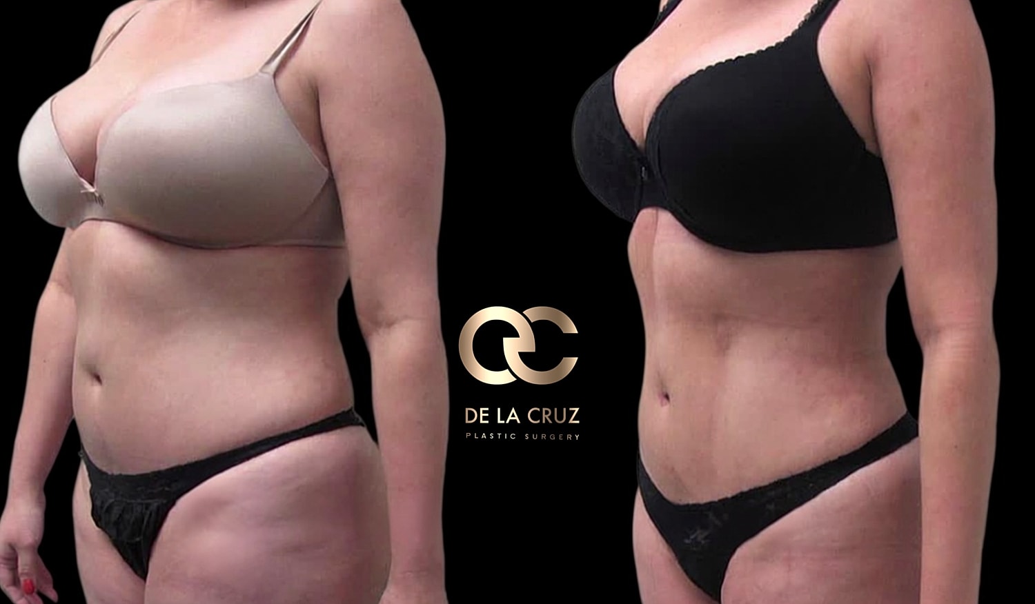 glp 1 vs liposuction Liposuction After GLP-1 Weight Loss: Understanding Skin Retraction and the Fibroseptal Network