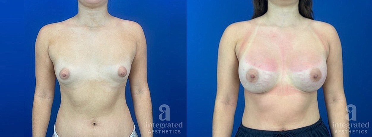 Before and after breast enhancement result by Dr. Climov – youthful patient case