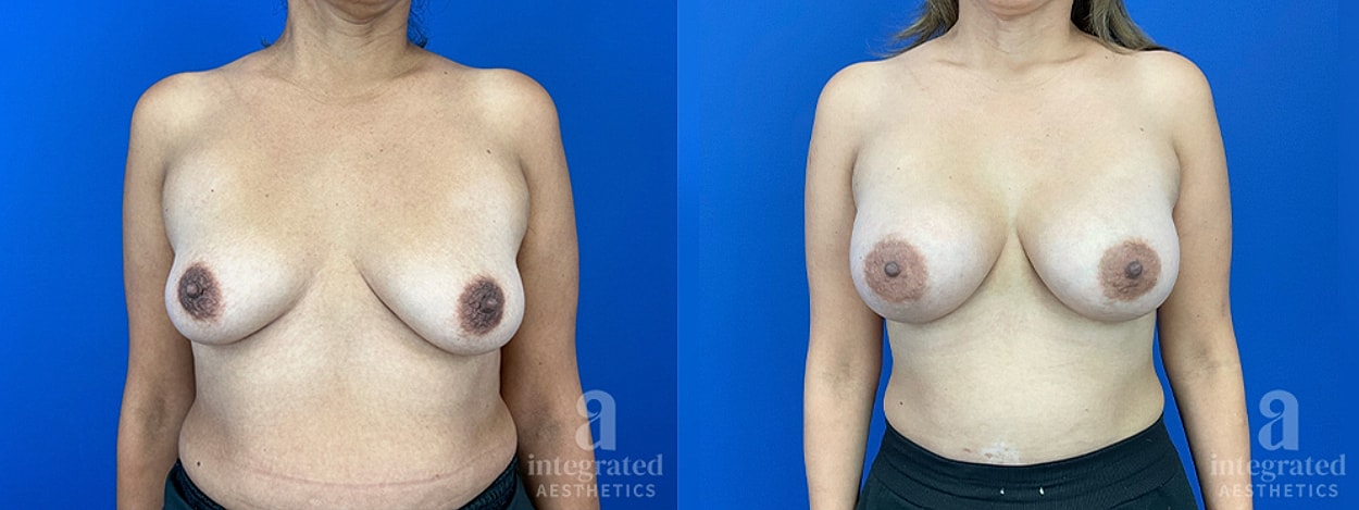 Post-weight loss breast augmentation and lift result by Dr. Climov