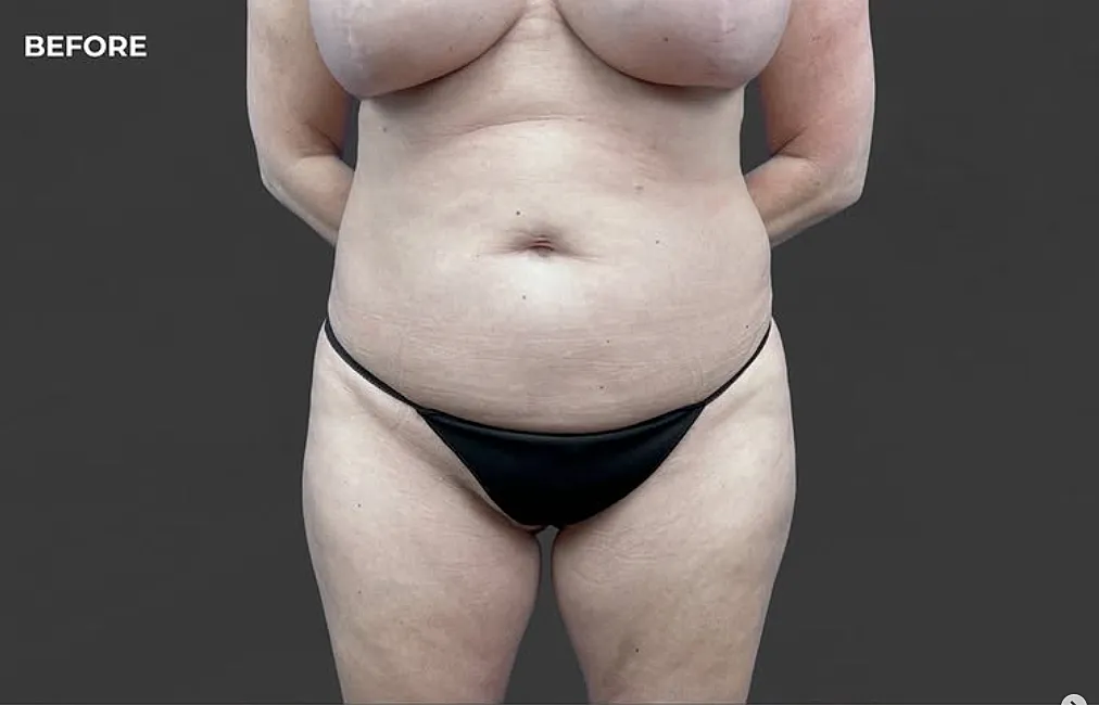 Tummy Tuck Before Photo