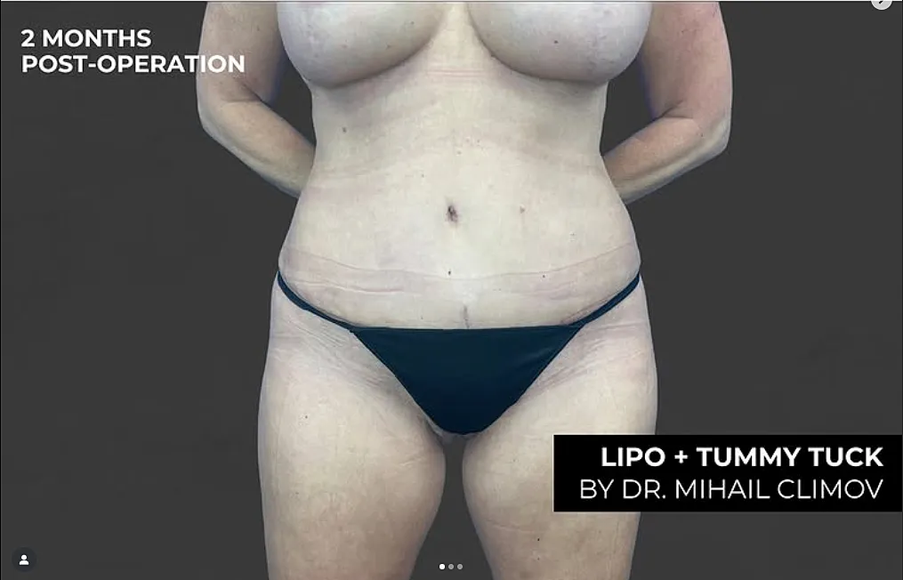 Tummy Tuck After Photo