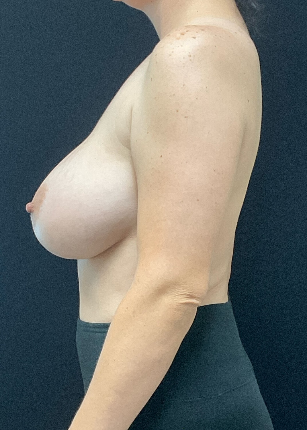 Breast Implant Revision Before & After