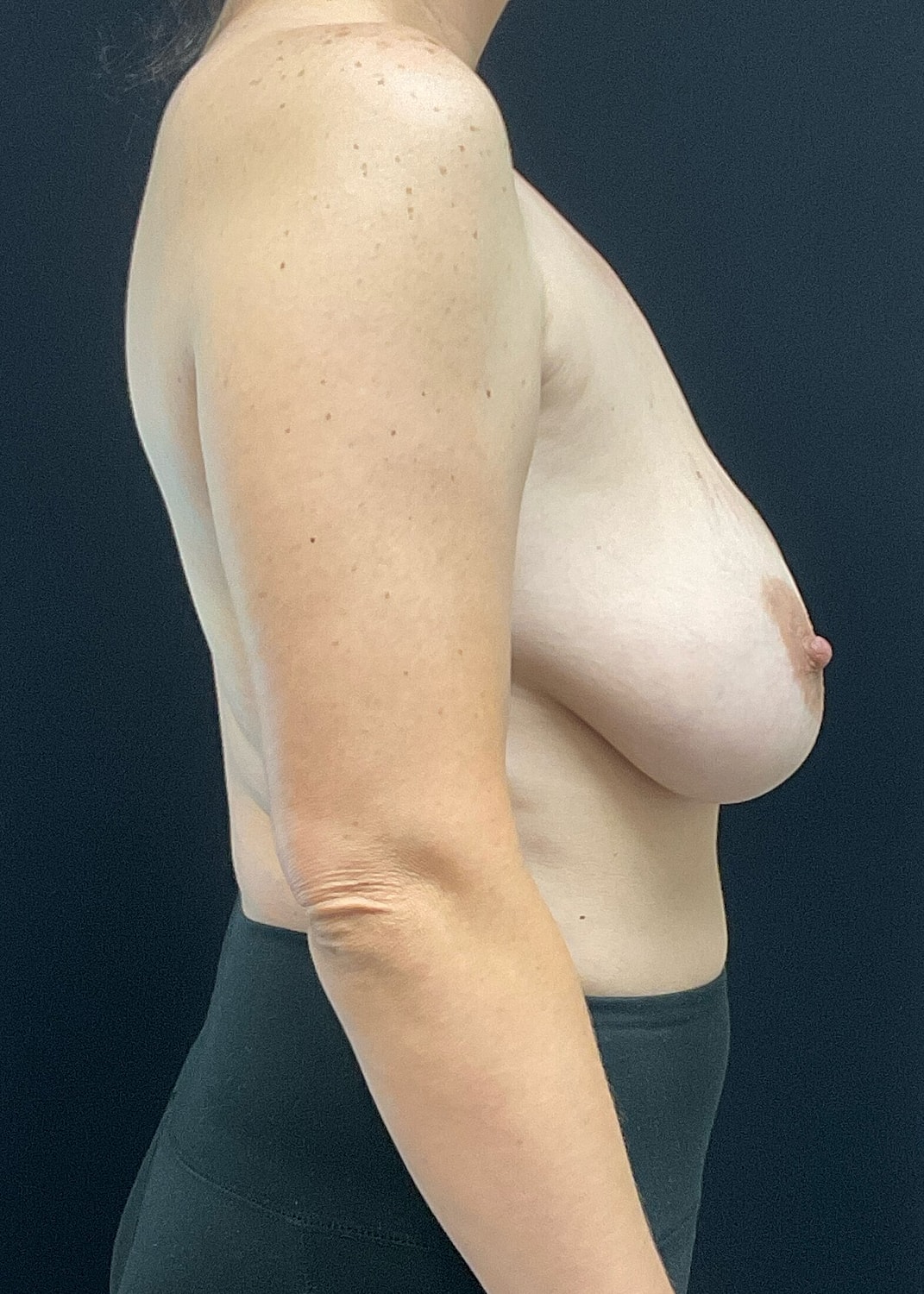 Breast Implant Revision Before & After