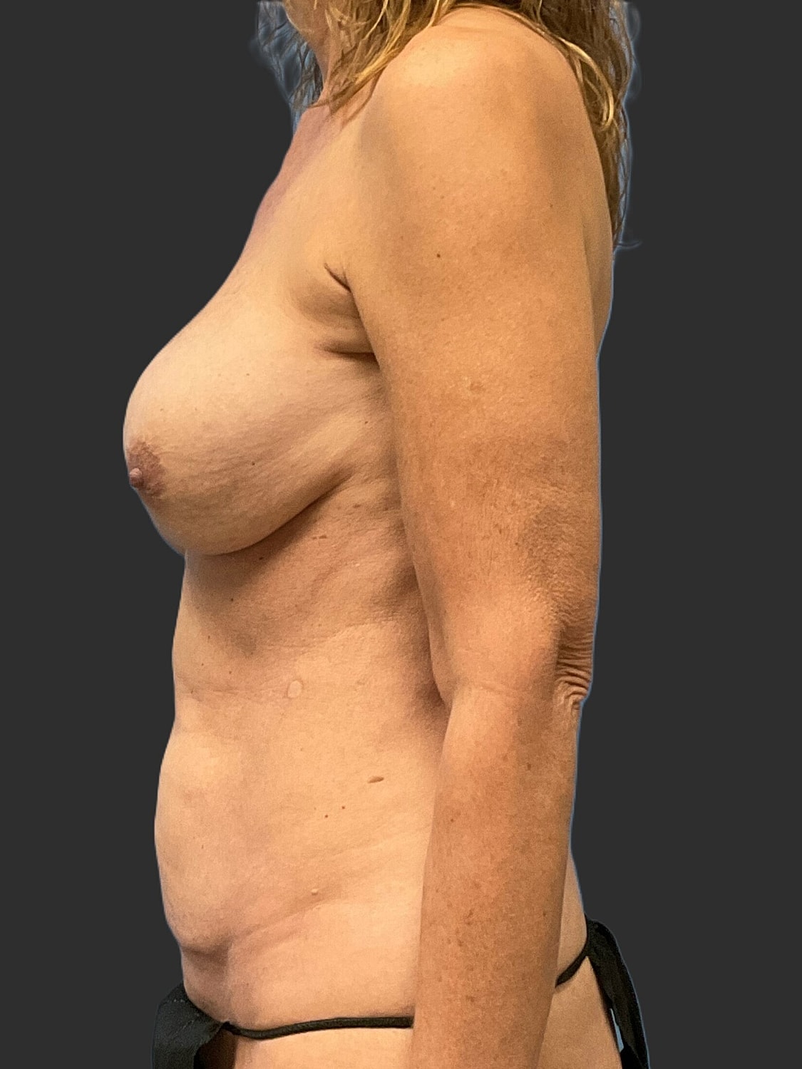 Mini Tummy Tuck Before & After