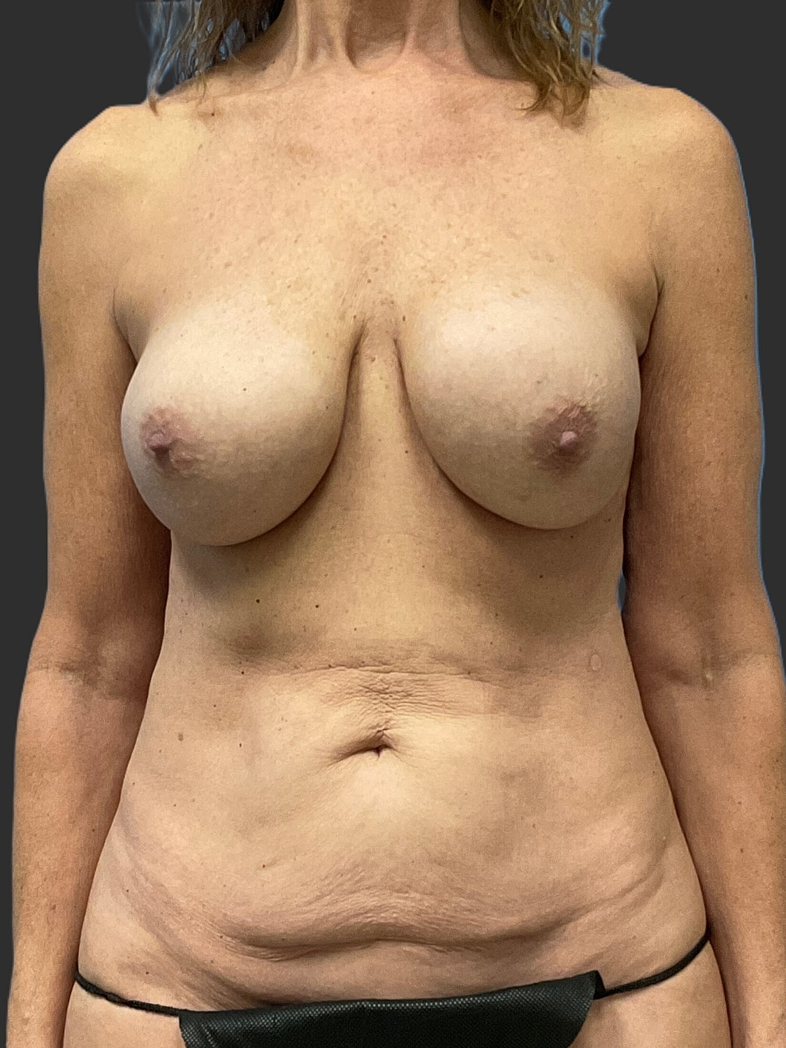 Mini Tummy Tuck Before & After