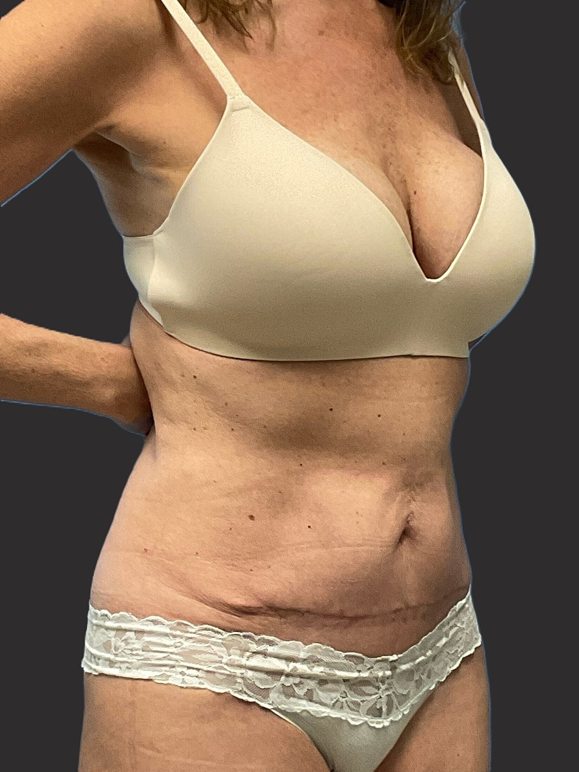Mini Tummy Tuck Before & After